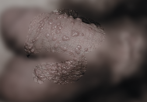 울산 비뇨기과 피부병] 남자 성기 돌기, 혹, 성기 뾰루지의 원인과 치료 : 네이버 블로그