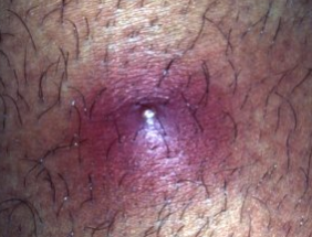 울산 비뇨기과 피부병] 남자 성기 돌기, 혹, 성기 뾰루지의 원인과 치료 : 네이버 블로그