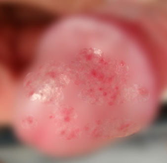 울산 성기 피부병] 귀두 붉은 반점의 원인- 칸디다 귀두염의 증상, 검사와 치료 : 네이버 블로그