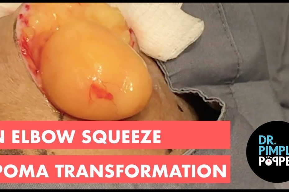 An Elbow Squeeze Lipoma Transformation! - Youtube